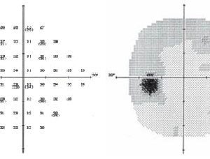 Visual Field Testing Manual and Automated